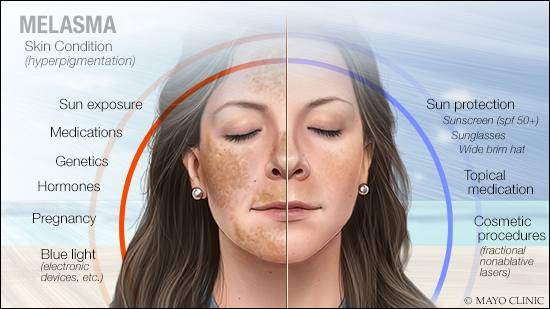 skincare ingredients to avoid during pregnancy - Hydroquinone